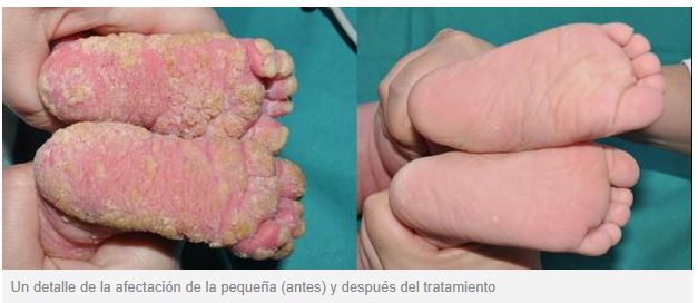 Investigadores de los Hospitales Gregorio Marañón y Niño Jesús descubren un tratamiento para un tipo de ictiosis. imagen