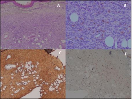 Pigmented Dermatofibrosarcoma Protuberans: Description of a pediatric case. imagen